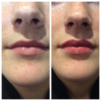 before and after of lip fillers